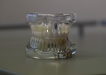 Implantes Madrid para dentatura postiza